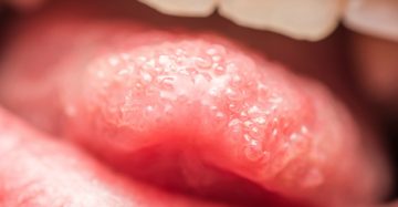how long does it take to get your taste buds back after burning how long does it take to get your taste buds back after burning