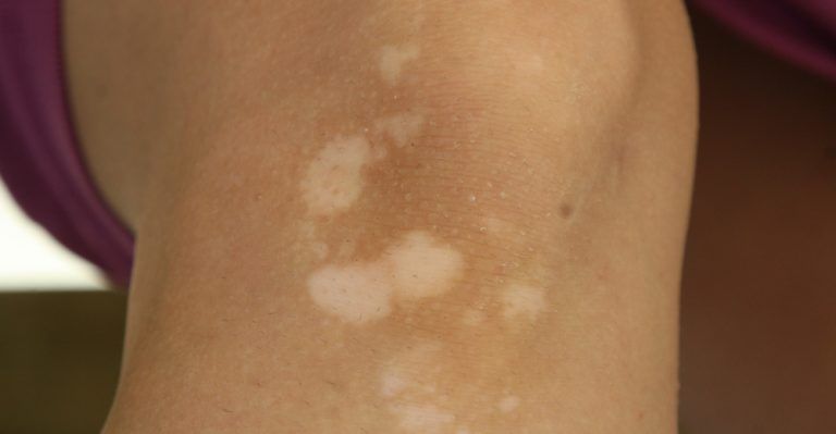 Do You Know What Your Birthmark Says About Your Personality Mq